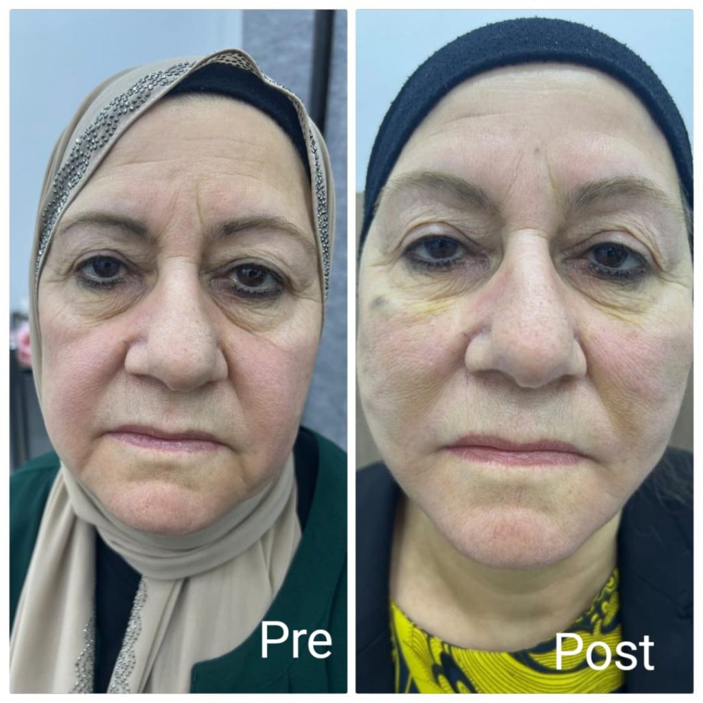 تكبير الخدود في الغردقة